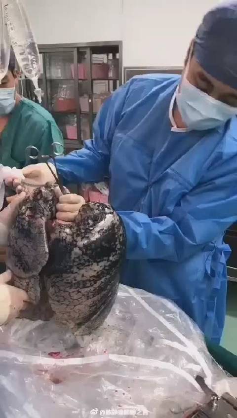 慎入烟龄30年捐献者的肺你还敢抽烟吗